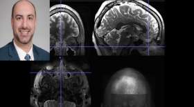 تاثیر سینوزیت مزمن بر فعالیت مغز