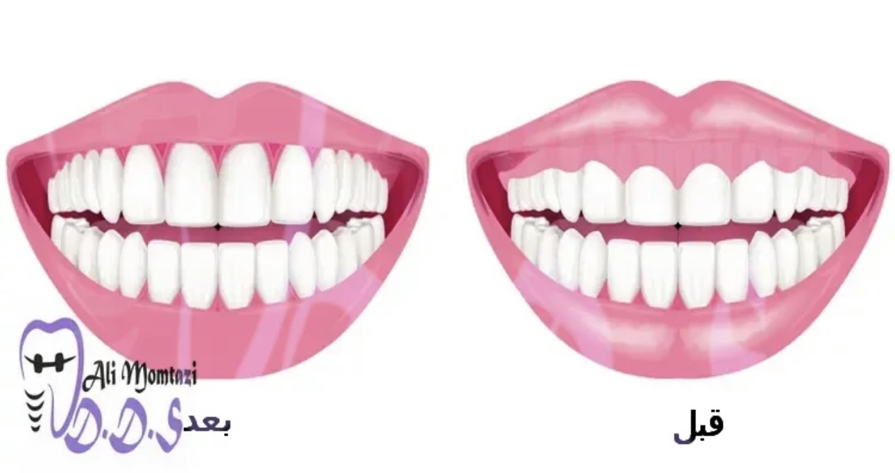 زیبایی لثه در دندانپزشکی دکتر علی ممتازی