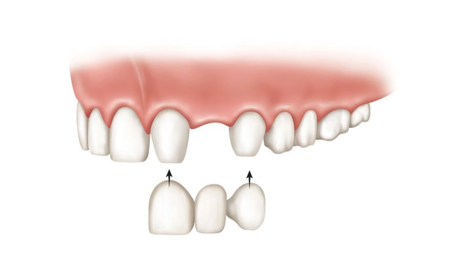 7 مورد از مشکلات بریج دندان