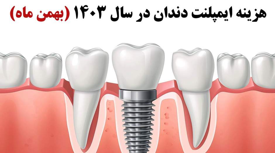 هزینه ایمپلنت دندان در تهران