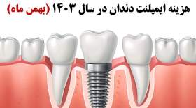 هزینه ایمپلنت دندان در تهران